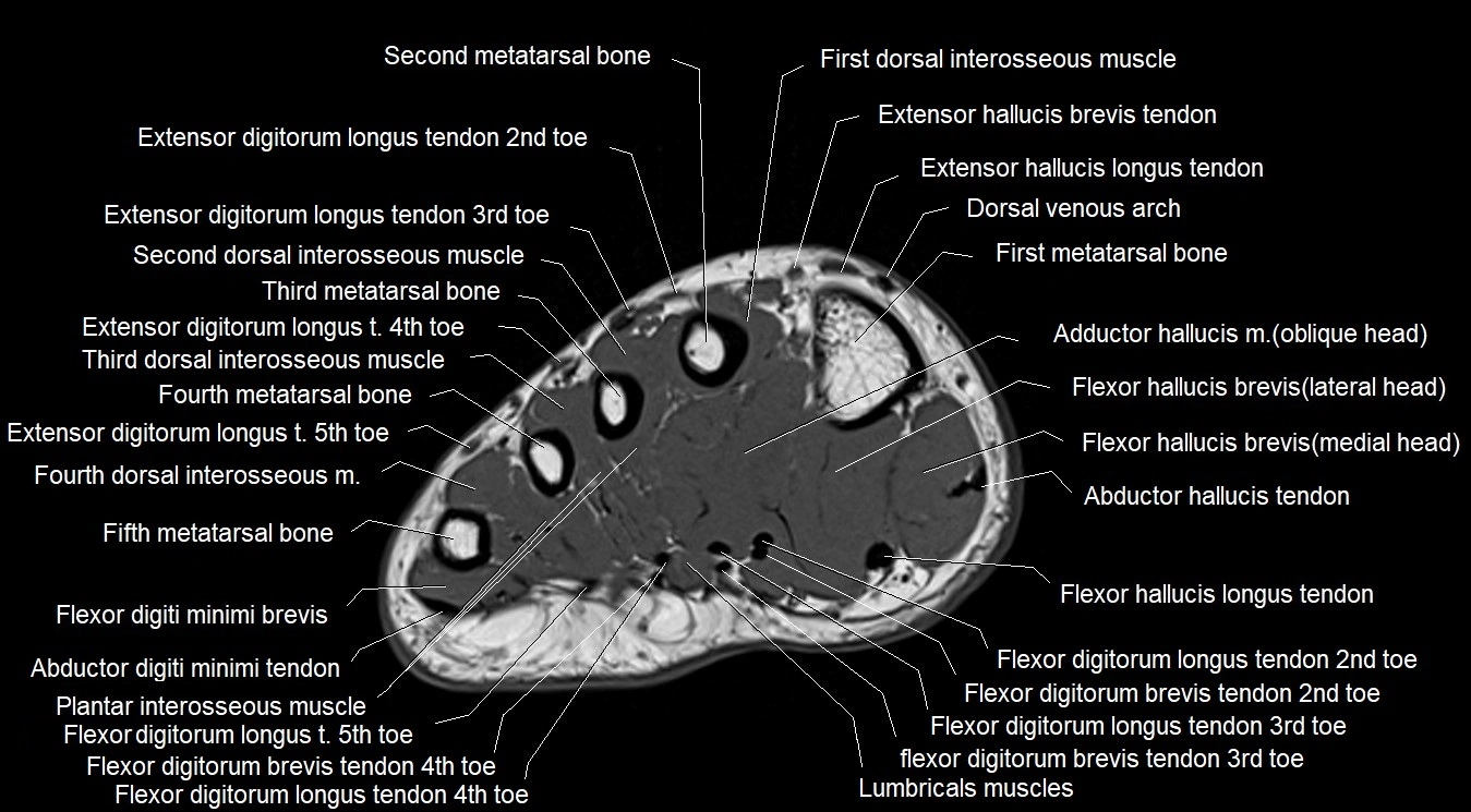 MRI 3T foot axial cross sectional anatomy image 18.webp